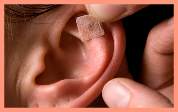 auriculoterapia